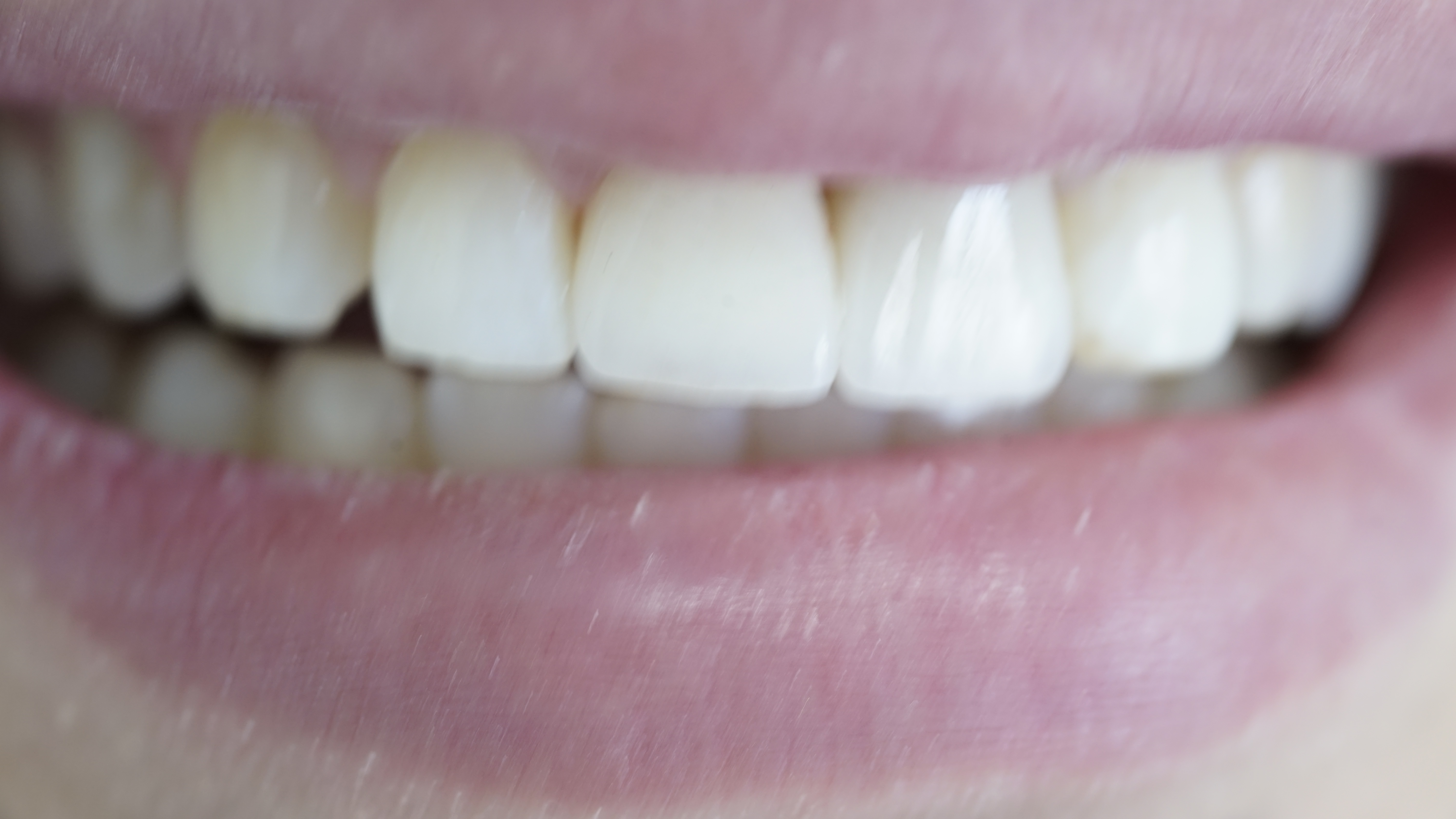 După · Implant unitar zona frontală